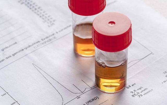 尿隐血三个加号